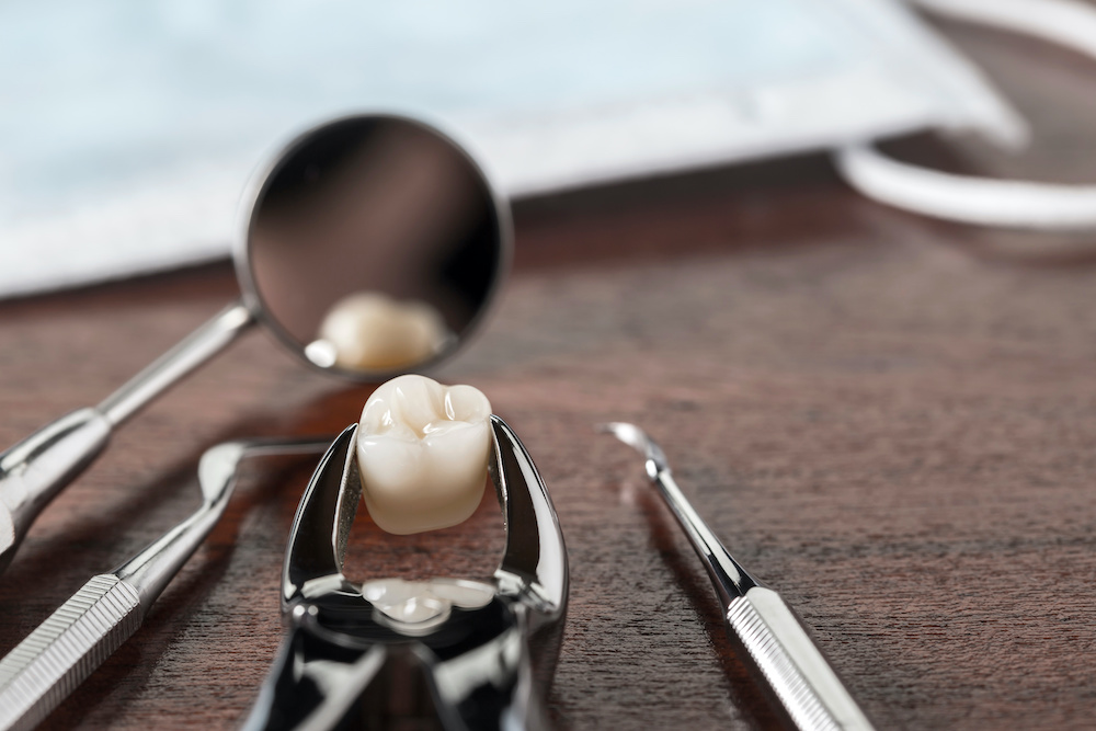 wisdom tooth extraction