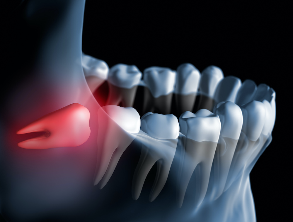 wisdom tooth removal