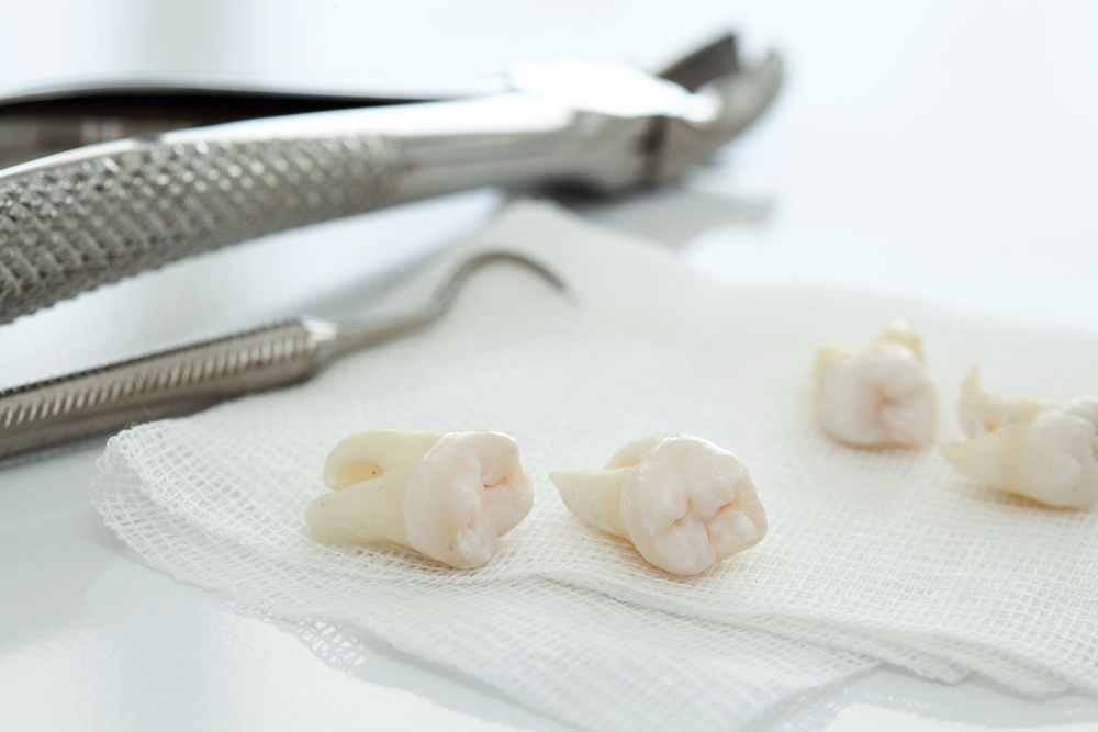 wisdom tooth removal