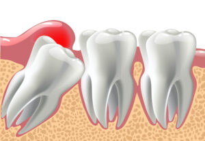 impacted tooth