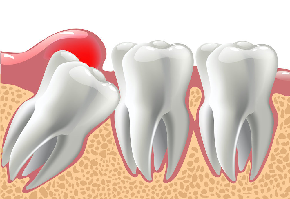 impacted tooth